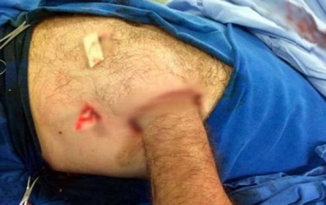 Le salvan la mano a un hombre cosiéndola en su abdomen
