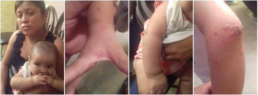 Alarma presencia de sarna en niños de Nuevo Laredo