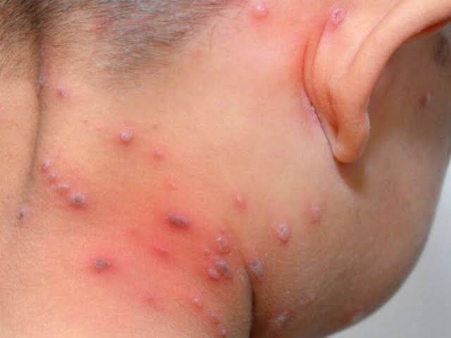 Brote de varicela en guarderias de Altamira