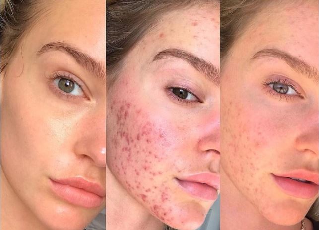 Modelo eliminó el acné con esta dieta…