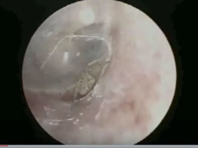 Tenía comezón en el oído y le encontraron una araña tejiendo una pequeña telaraña
