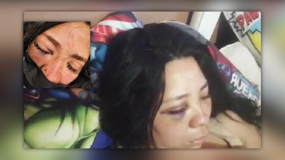 Próximo regidor suplente en Madero es denunciado por golpear a ex pareja; joven podría perder el ojo