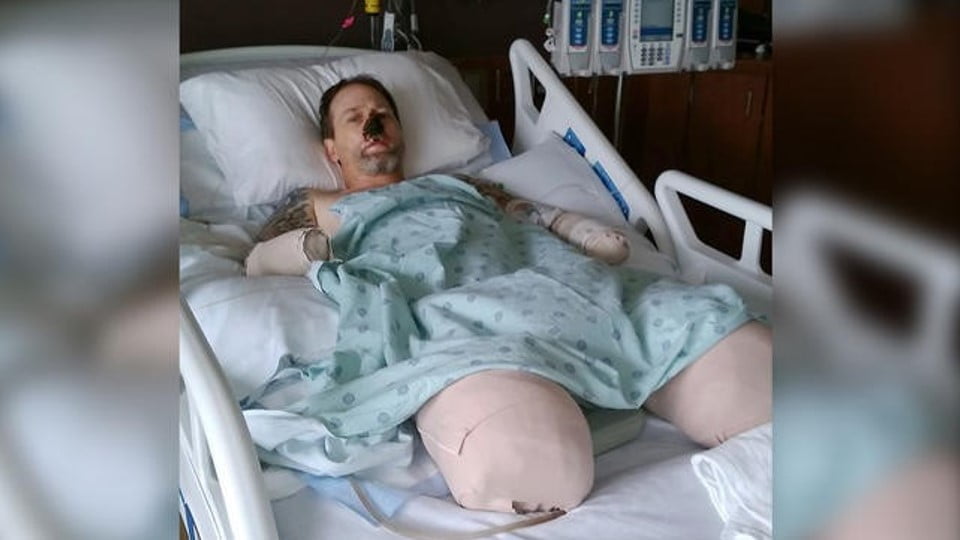 Hombre pierde las piernas y parte del rostro, por dejarse lamer por su perro