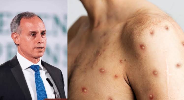 Confirma López-Gatell primer caso importado de viruela del mono en México