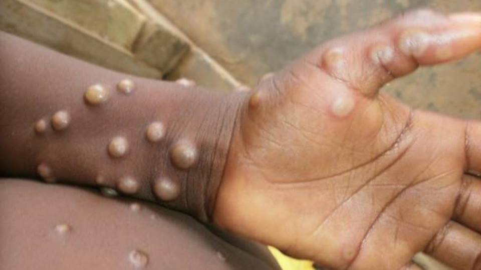 Aumenta a 131 los casos de viruela del mono en 17 países