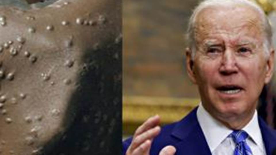 Joe Biden advierte que la viruela del mono “debe preocuparnos”