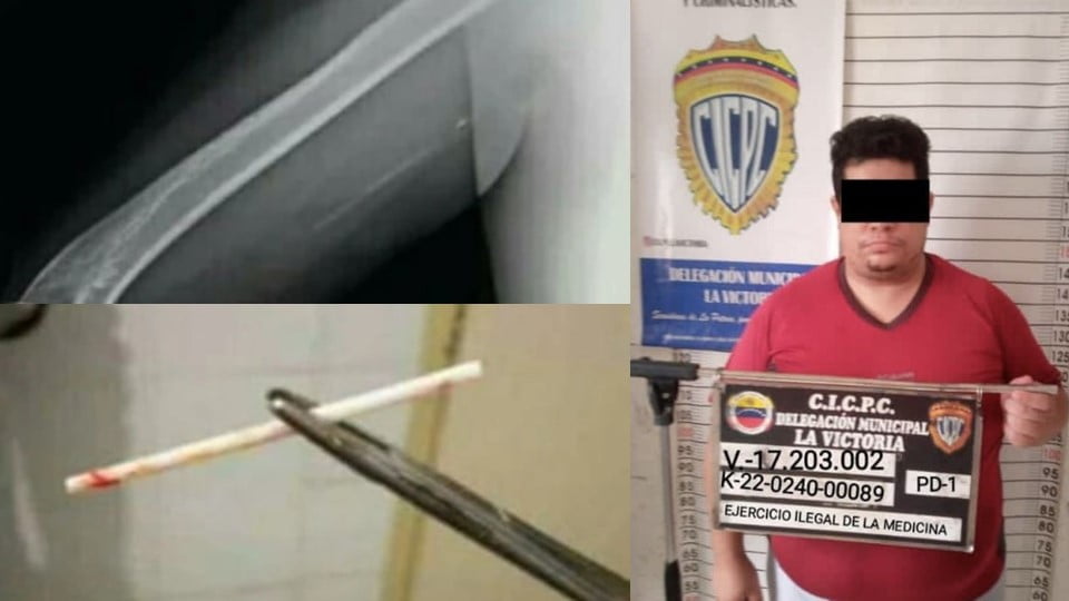 Falso ginecólogo puso palitos de paleta en lugar de implantes anticonceptivos