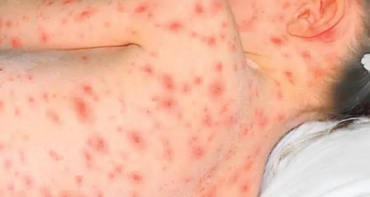 Siguen aumentando casos de varicela en Tamaulipas