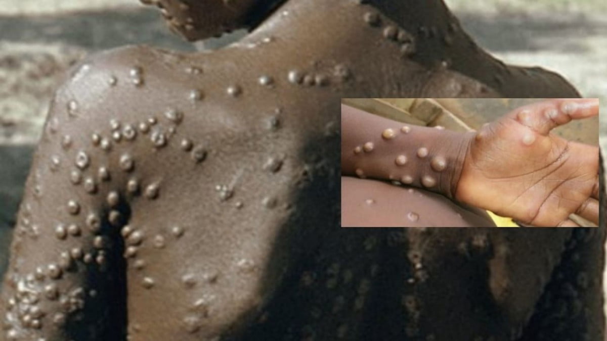 Se activan protocolos de vigilancia epidemiológica por viruela de del mono en Tamaulipas