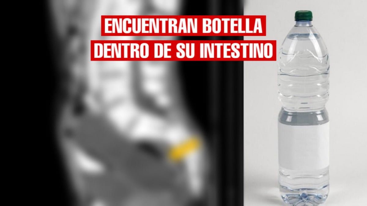 Creyó que estaba estreñido hasta que médicos encuentran botella en su intestino grueso