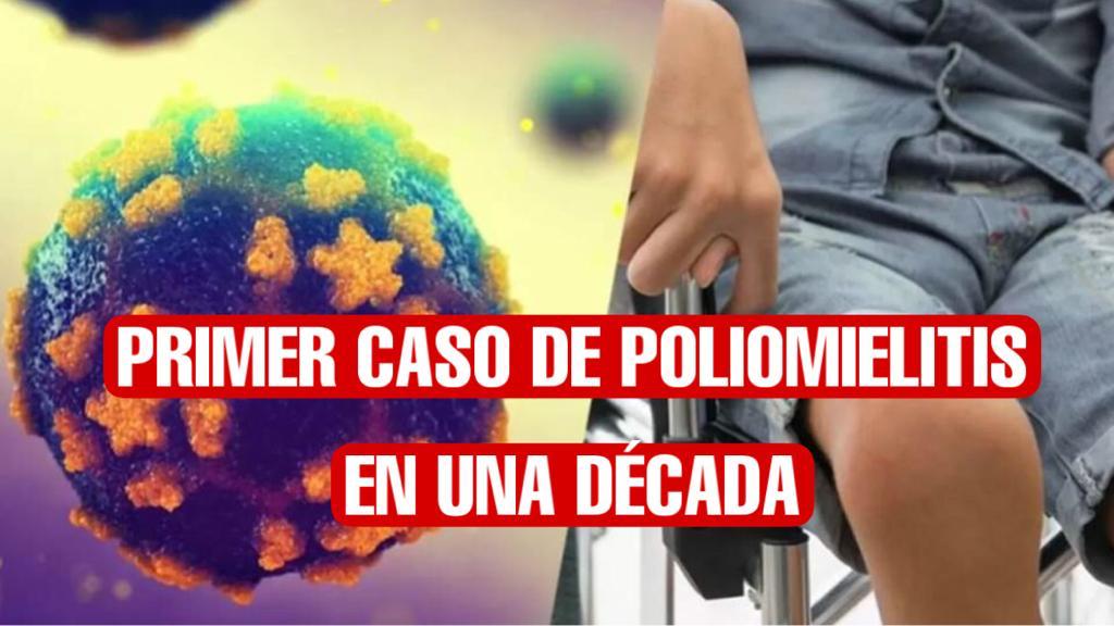 Reportan el primer caso de poliomielitis en casi una década