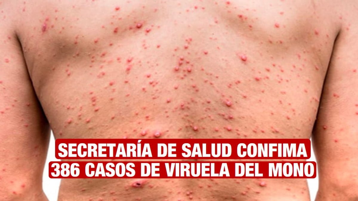 Secretaría de Salud confirma 386 casos de viruela del mono