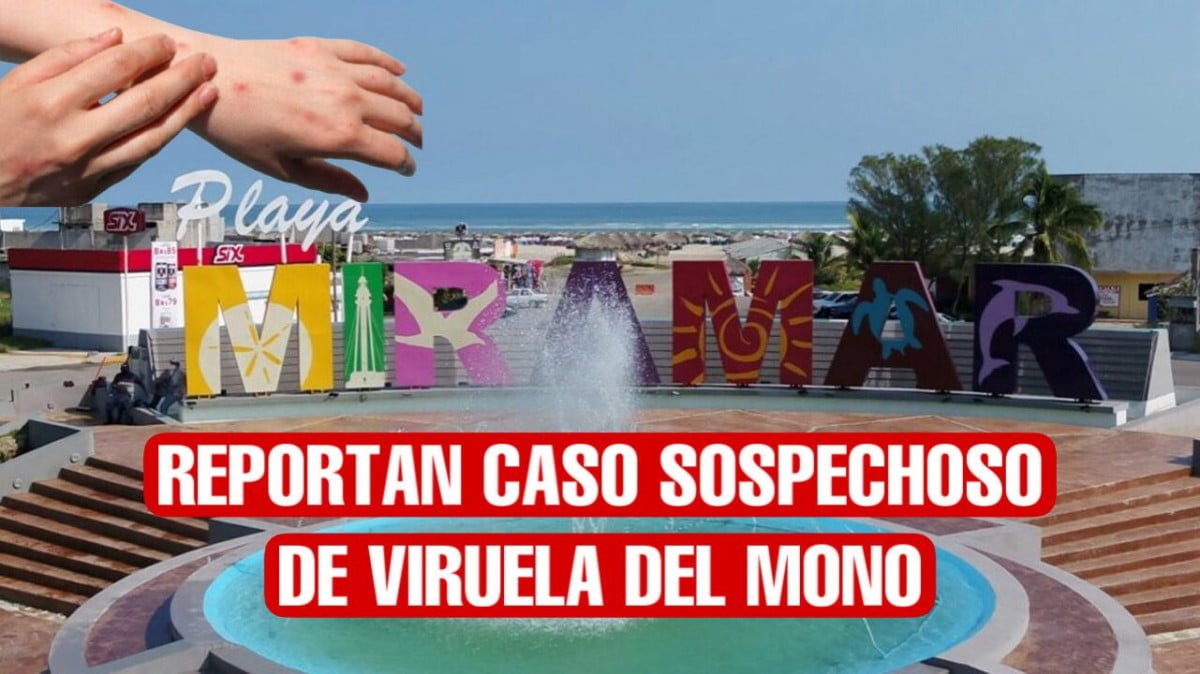 Reportan caso sospechoso de viruela del mono en playa Miramar; aplican cerco sanitario