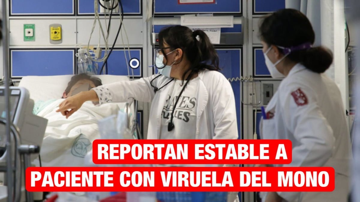 Reportan estable a paciente con viruela del mono en Tampico