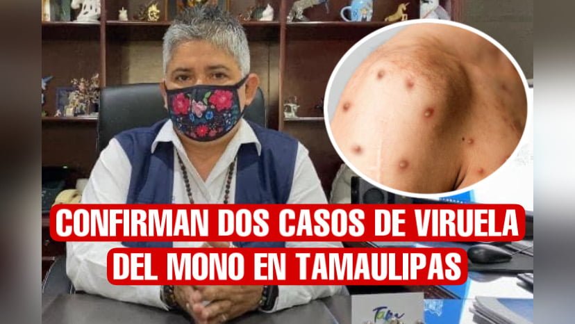 Confirman dos casos de viruela del mono en Tamaulipas