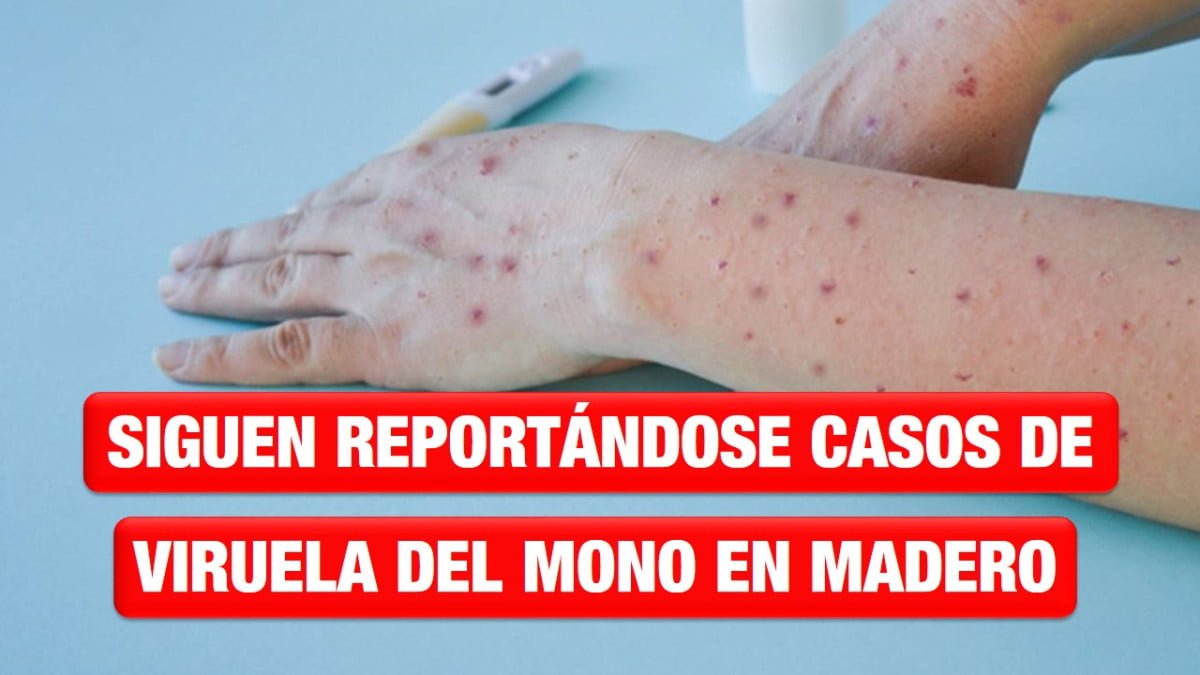 Siguen reportándose casos de viruela del mono en Madero