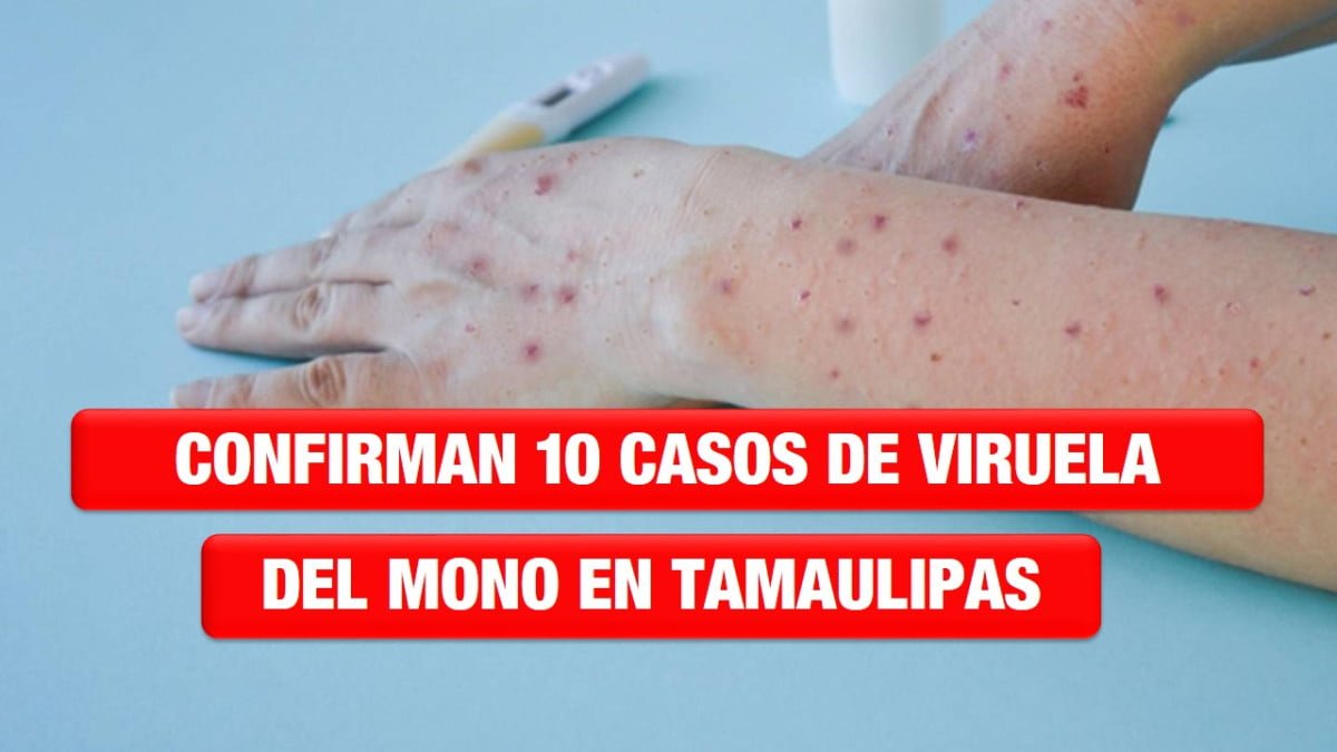 Confirman 10 casos de viruela del mono en Tamaulipas