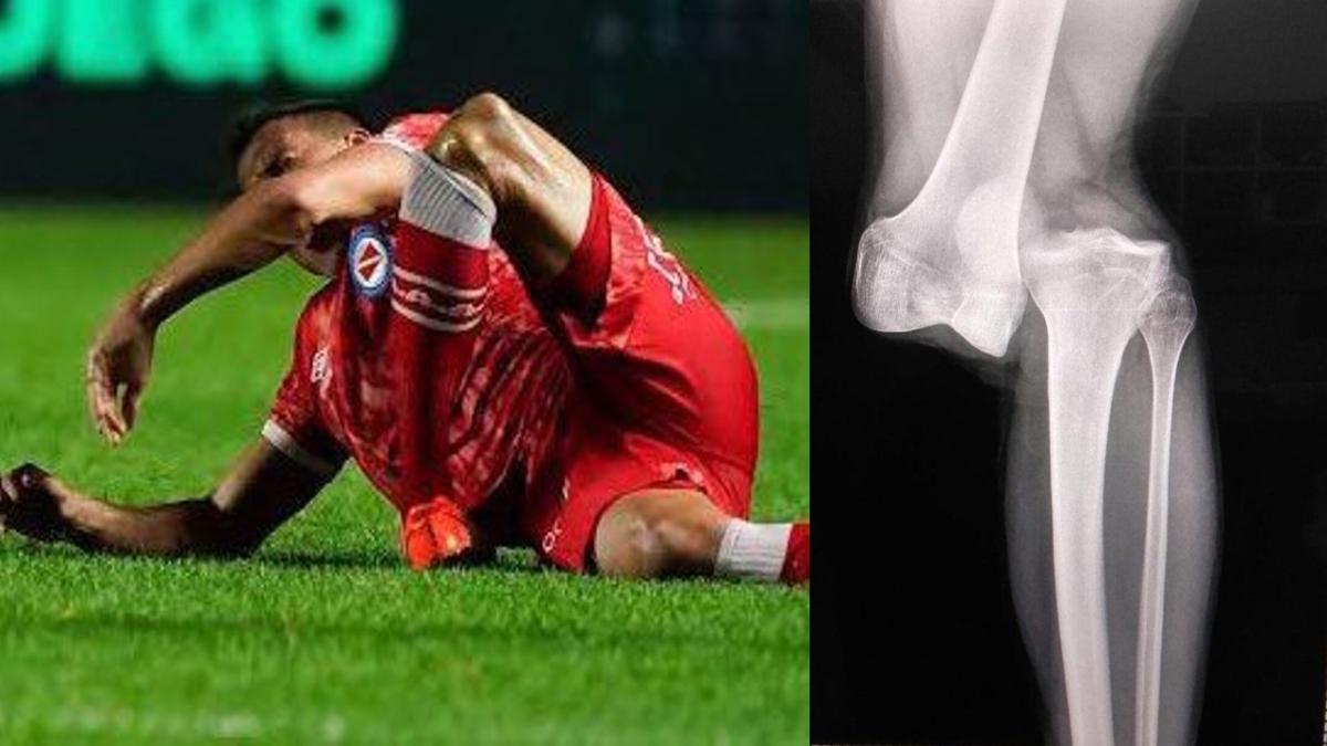 Un año fuera de la cancha Luciano Sánchez tras fractura de pierna en partido