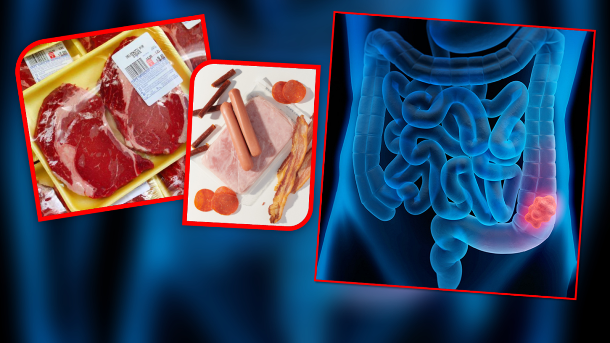 Consumo de carne procesada se asocia a cáncer colorrectal