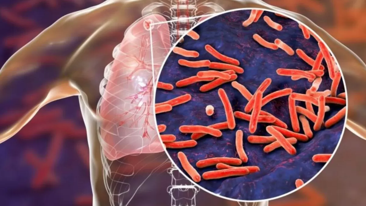 México registra más de 7 mil casos de tuberculosis
