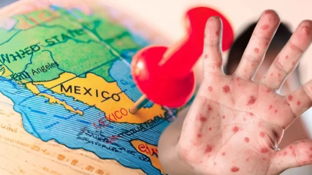 México reporta fuerte aumento de viruela del mono; van 174 casos