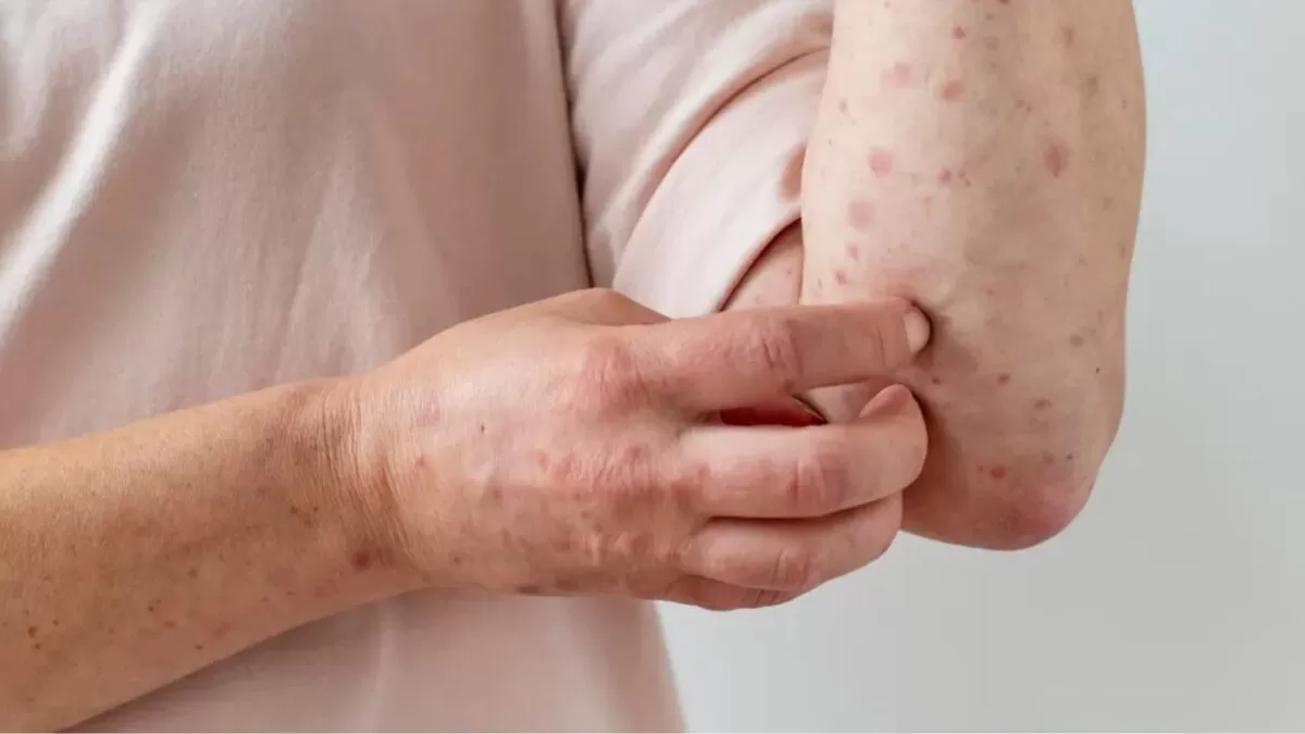 Tamaulipas registra 9 casos de sarampión; está en top 4 nacional