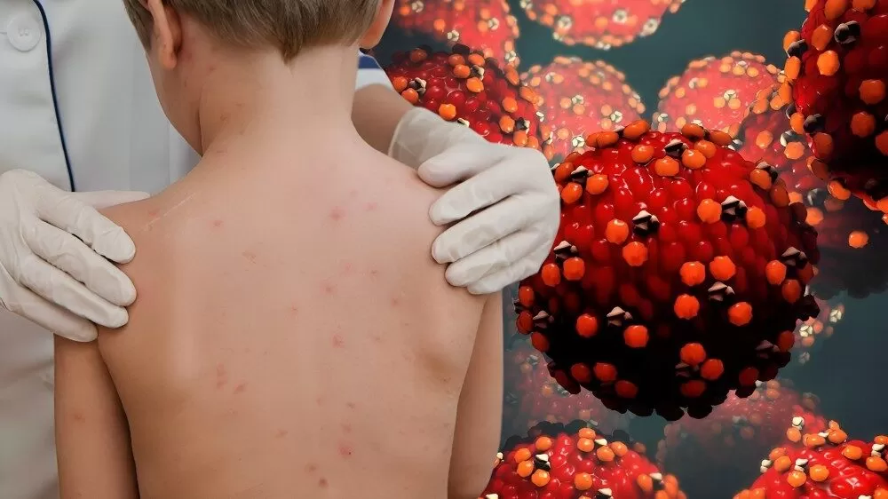 Refuerzan alerta en Tamaulipas por casos importados de sarampión