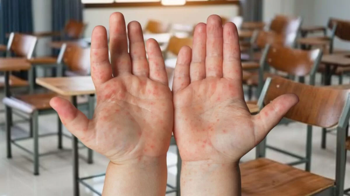 Coxsackie: el brote silencioso que está cerrando escuelas en Tamaulipas
