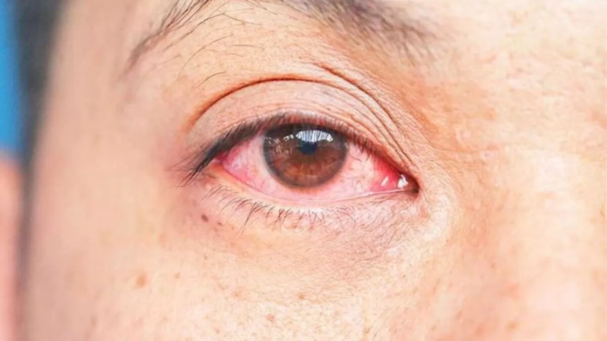 Lluvias detonan brote de conjuntivitis en Tamaulipas; superan los 700 casos