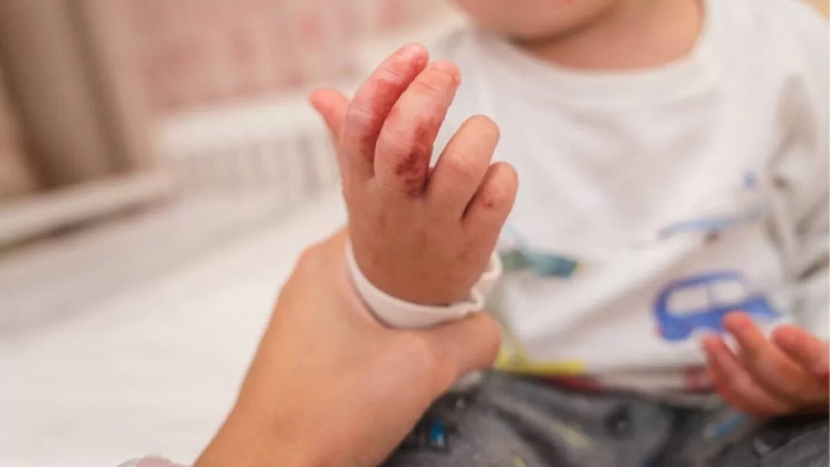 Piden reforzar medidas de higiene ante brote de virus Coxsackie en Tamaulipas