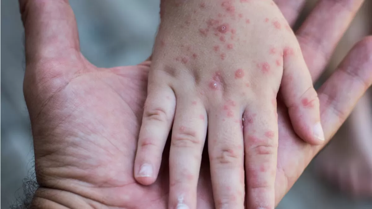 Detectan brote de virus Coxsackie en escuelas de Tampico