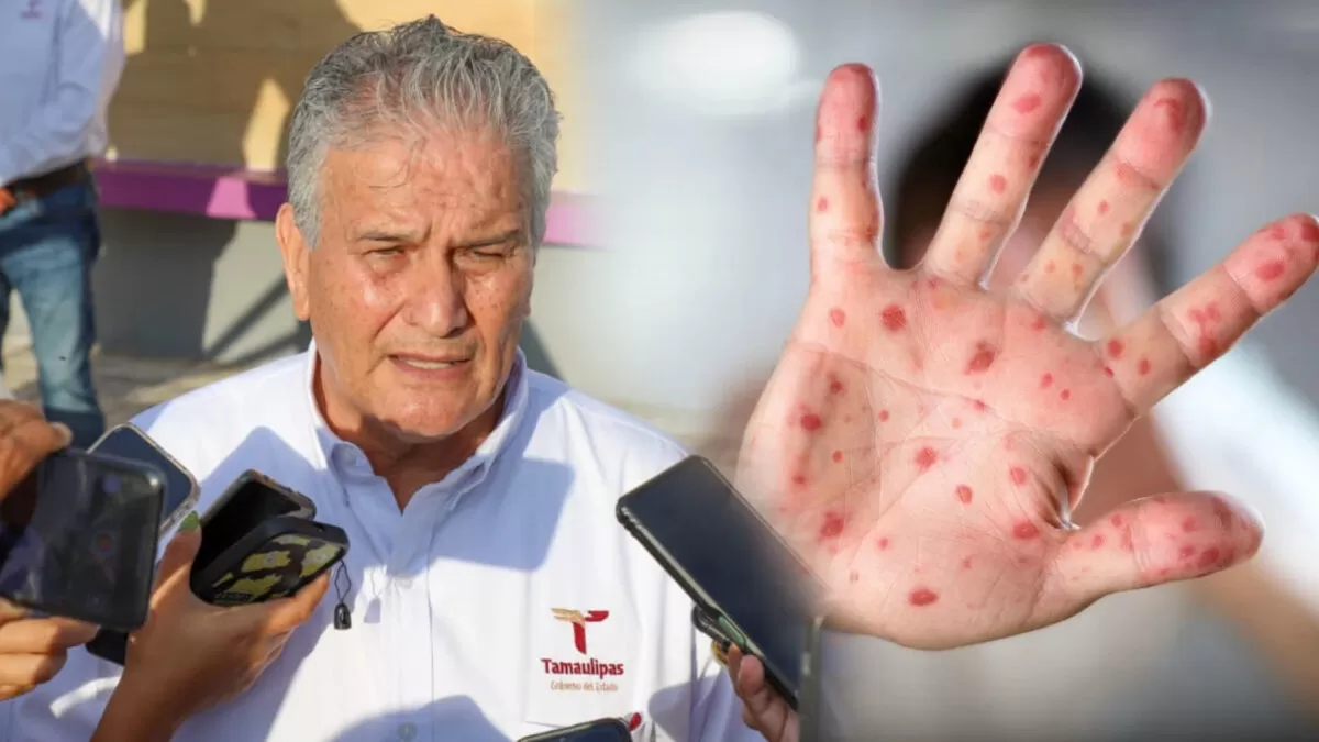 Refuerza Tamaulipas prevención ante virus de manos, pies y boca