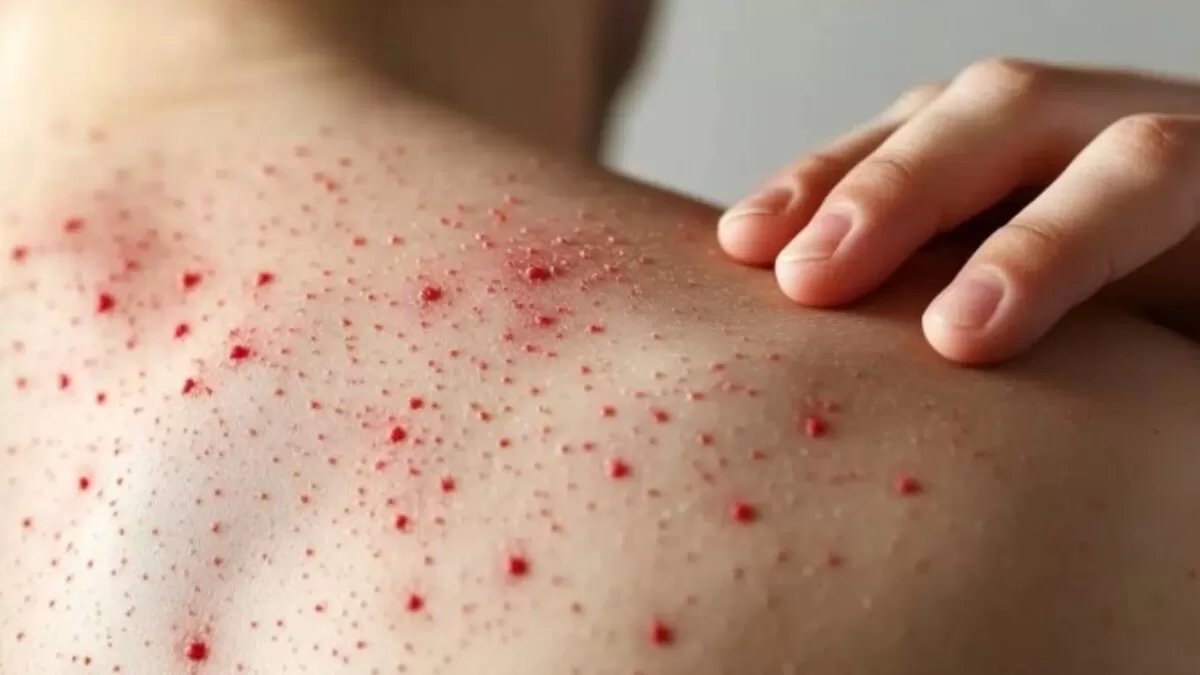 Sarampión: 23 fallecidos desde febrero y contagios en descenso