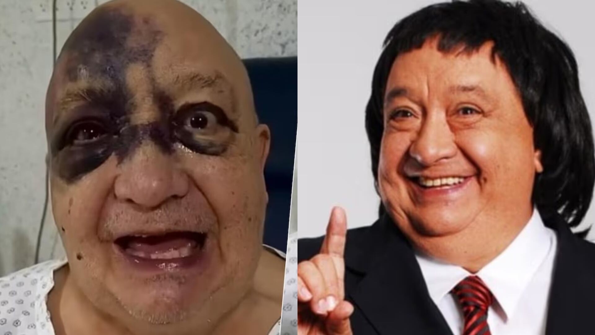 Luis de Alba “el Pirruris” reaparece con la cara destrozada por fuerte accidente